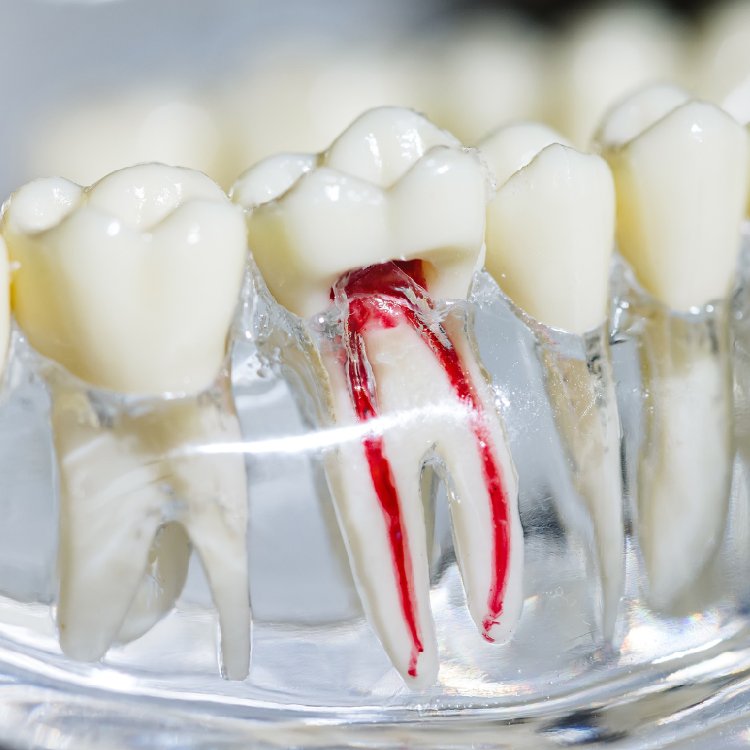 endodoncia